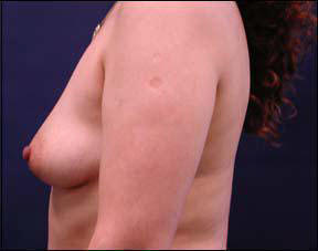 38 year old female Chicago Breast Augmentation Pictures