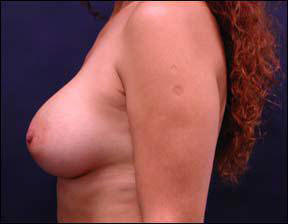 38 year old female Chicago Breast Augmentation Photo