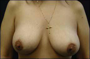30 year old female Chicago Breast Augmentation Photo