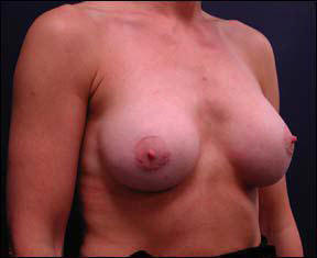 23 year old athletic female Chicago Breast Augmentation photos