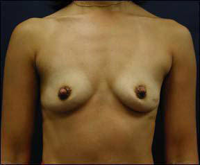39 year old female Chicago Breast Augmentation Pictures