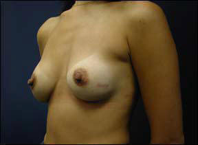 39 year old female Chicago Breast Augmentation Photo