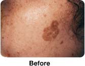 Laser Mole Removal - Patient Treatments