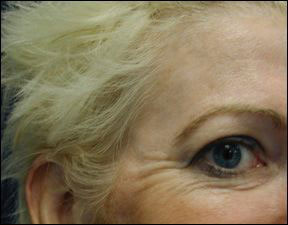 Anti Wrinkle - Men and Women