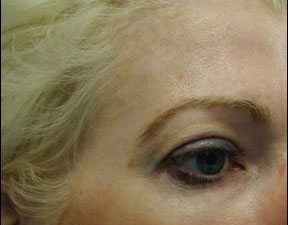 Chicago Botox, Chicago Botox Injections, Chicago Botox Cosmetic Injections, Chicago Botox Cosmetic