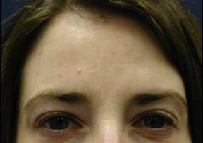 Chicago Botox, Chicago Botox Injections, Chicago Botox Cosmetic Injections, Chicago Botox Cosmetic