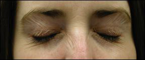 Chicago Botox, Chicago Botox Injections, Chicago Botox Cosmetic Injections, Chicago Botox Cosmetic