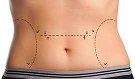 Dr. Speron has extensive experience with Body Contouring & Body Reshaping. 