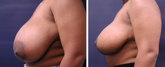 Breast Reduction Surgery : Before and After Photos