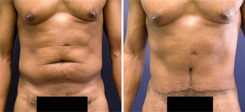 Gynecomastia reduction and tummy tuck after massive weight loss 3809