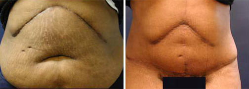 Tummy Tuck Surgery Before and After Pictures