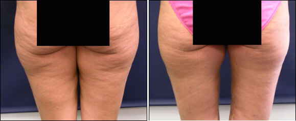 Thigh Lift Surgery Before and After Pictures
