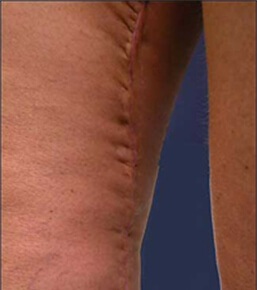 Short Scar Inner Thigh Contouring: Oblique Technique