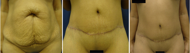 What Real Tummy Tuck Scars Look Like On 12 Patients