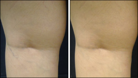 Spider Vein Removal Before and After Pictures